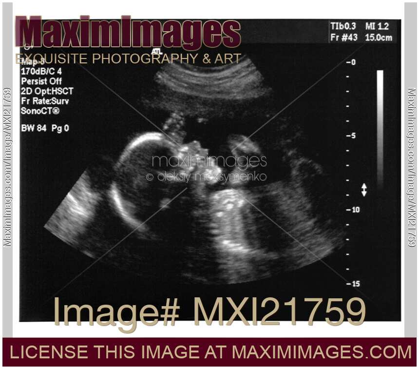 Ultrasound Imaging of a baby fetus